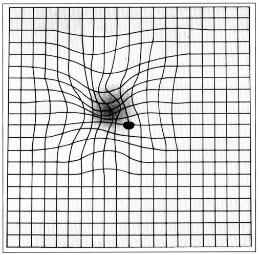 Amsler grid with curved, distorted lines