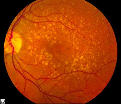Fundus photograph with dry macular degeneration