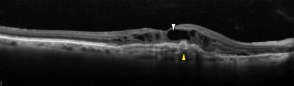 OCT scan showing macular edema in wet macular degeneration