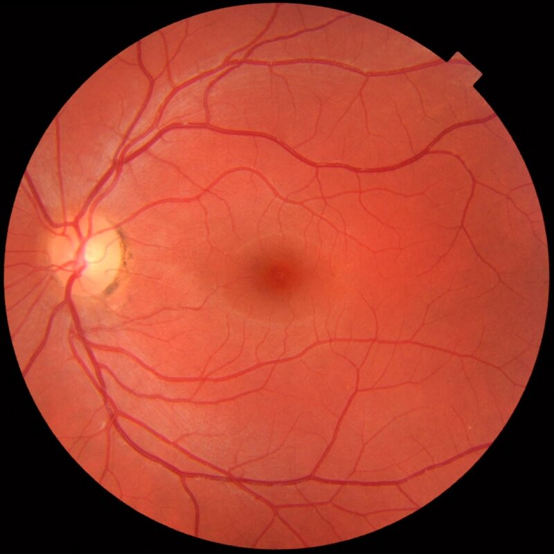 Fundus photograph of a healthy eye