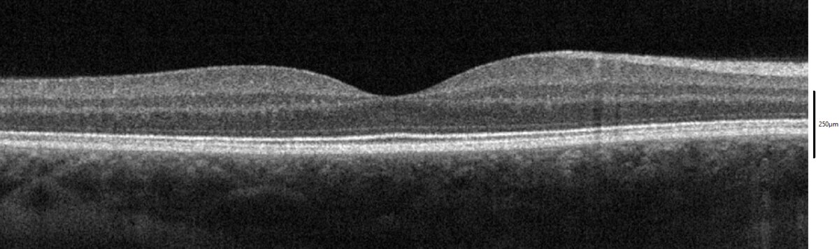 OCT scan of a normal macula