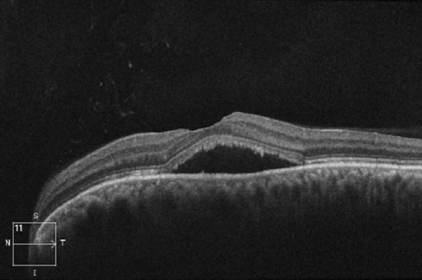 OCT scan showing dark fluid under the retina