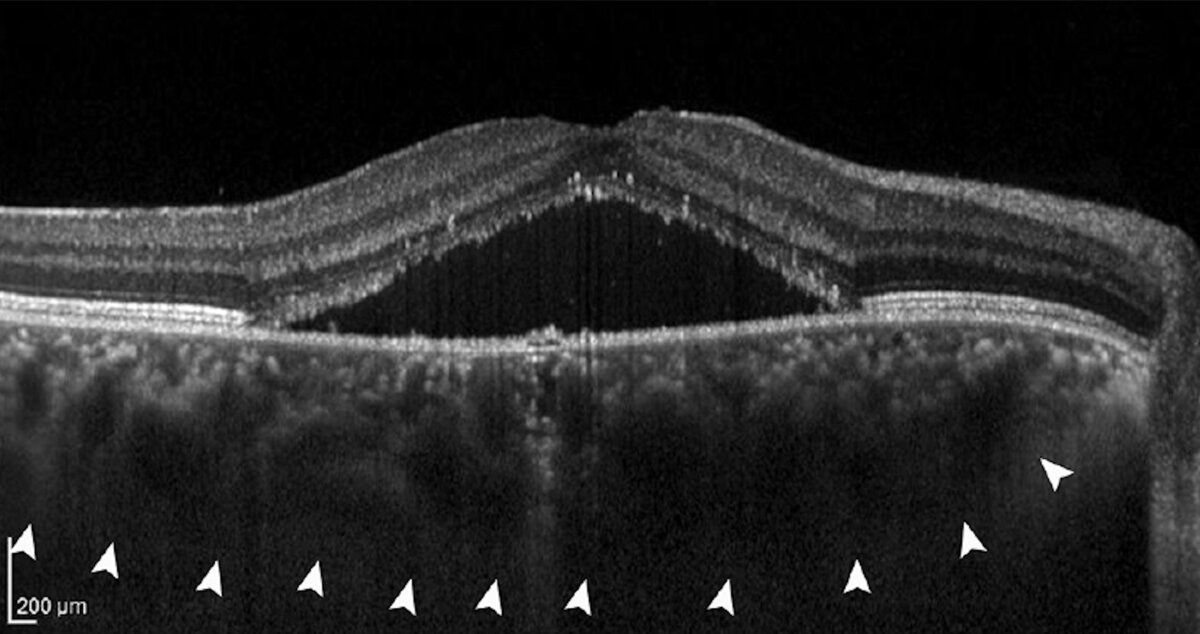 OCT scan showing fluid under the retina and a thickened choroid