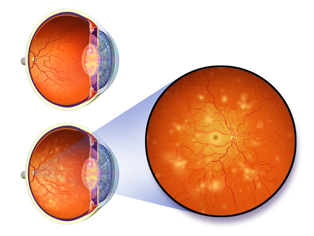 Illustration comparing a healthy eye with an eye affected by diabetic retinopathy