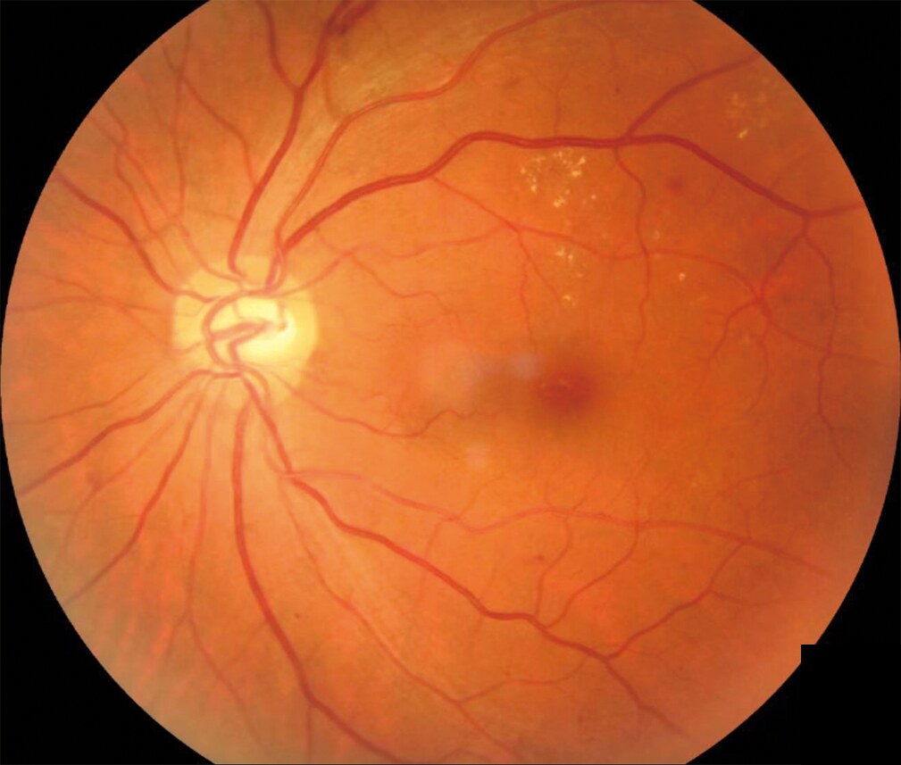 Fundus photograph with hemorrhages and exudates from diabetic retinopathy