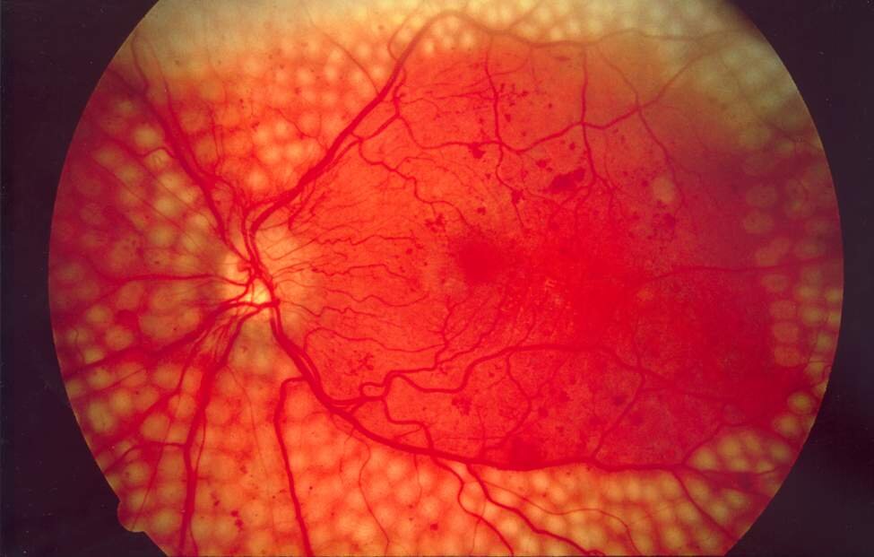 Fundus photograph after panretinal laser photocoagulation