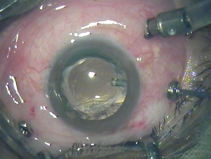 View through the operating microscope during vitrectomy, with the surgical instruments inserted into the eye
