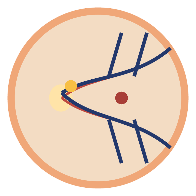 Schematic drawing of the retina with a blocked artery and a pale, poorly supplied area