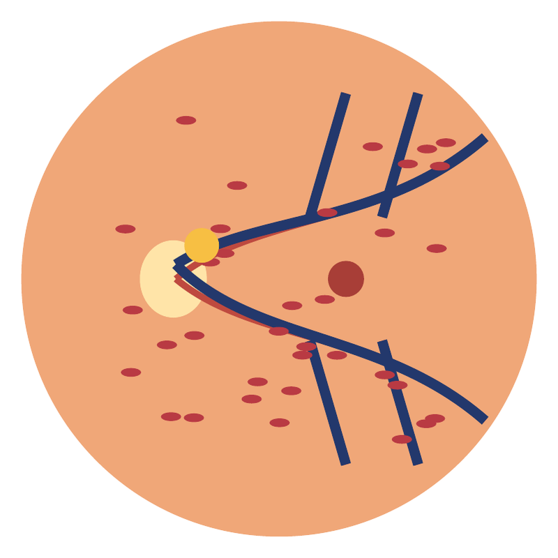 Schematic drawing of the retina with a blocked vein and scattered hemorrhages